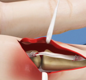 Tendon Repair Surgery img
