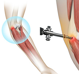 Tennis Elbow Surgery img