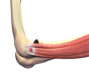 Tennis Elbow img