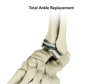 Total Ankle Replacement img