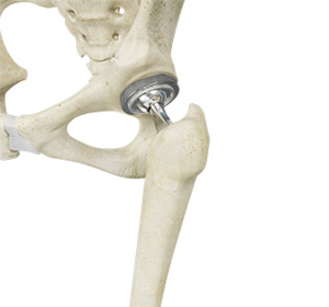 Total Hip Replacement img