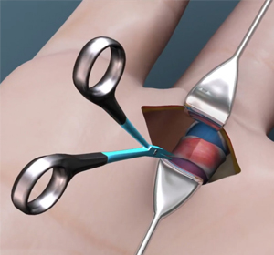 Trigger Finger Release img