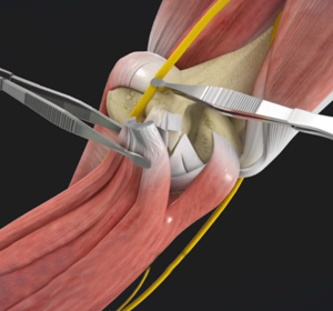 Ulnar Nerve Transposition img