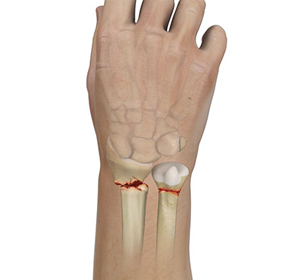 Wrist Fracture img