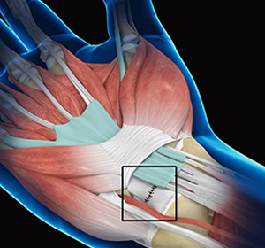 Wrist Ligament Reconstruction img