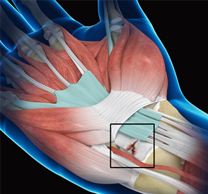 Wrist Ligament Tear and Instability img