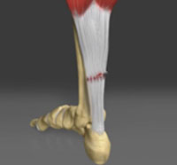 Achilles Tendinitis