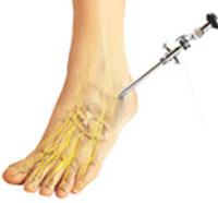Ankle Arthroscopy