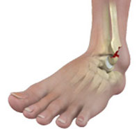 Ankle Fractures