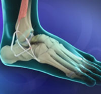 Ankle Ligament Reconstruction