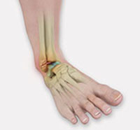 Broken Bones & Injuries