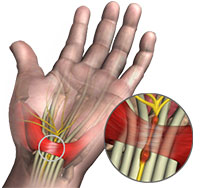 Non-Operative Treatment for Carpal Tunnel Syndrome