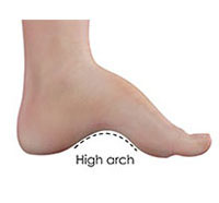 Cavus Foot Deformity