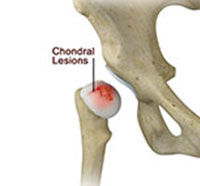 Chondral Lesions or Injuries