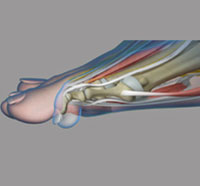 Common toe Deformities