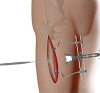 Complex Hip Reconstruction Surgery