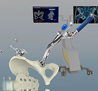 Computer Assisted Hip and Knee Joint Replacement