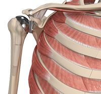 Conventional Shoulder Replacement