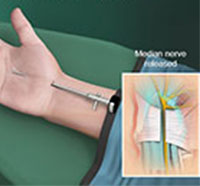 Endoscopic Carpal Tunnel Repair