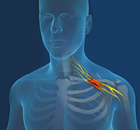 Erb's Palsy (Brachial Plexus Birth Palsy)