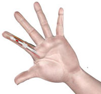 Flexor Tendon Injuries