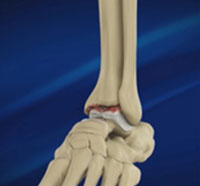 Foot & Ankle Osteoarthritis