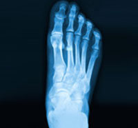 Stress Fracture of the Foot