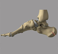 Fracture of the Calcaneus