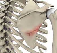 Clavicle Fracture (Broken Collarbone)