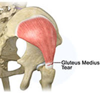 Gluteus Medius Tear