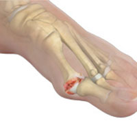 Hallux Rigidus