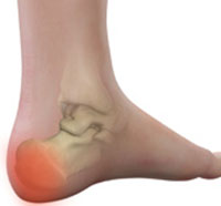 Heel Pain