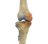 High Tibial Osteotomy