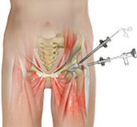 Hip Arthroscopy