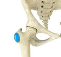 Hip Bursitis
