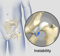 Hip Instability