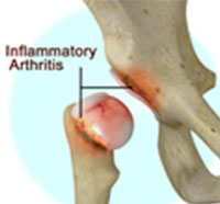 Inflammatory Arthritis of the Hip