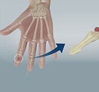 Joint Fusions of the Fingers & Wrist