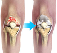 Unicompartmental Knee Replacement