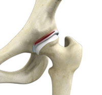 Hip Labral Tear
