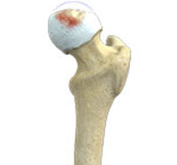 Legg-Calve-Perthes-Disease