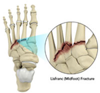 Lisfranc (Midfoot) Injury