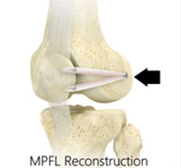Medial Patellofemoral Ligament Reconstruction