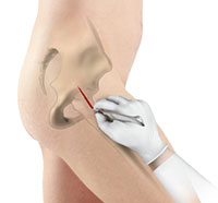 Minimally Invasive Total Hip Replacement