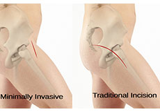 Minimally Invasive Joint Replacement