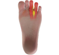 Morton's Neuroma