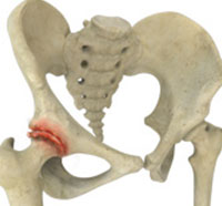 Osteoarthritis of the Hip