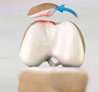 Patellar Dislocation/Patellofemoral Dislocation
