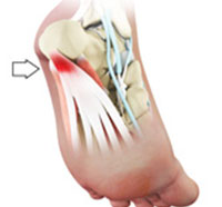 Plantar Fasciitis