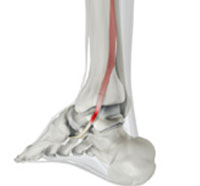 Posterior Tibial Tendon Dysfunction